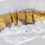 Разборная модель для изготовления металлокерамики