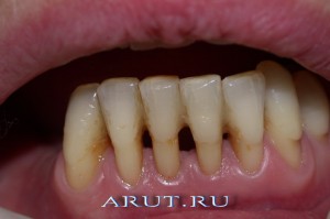 Фотографии адгезионной шины спустя 5 лет после шинирования.