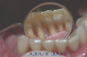 Фотографии адгезионной шины спустя 5 лет после шинирования.