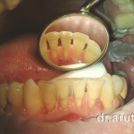 Отпрепарирована борозда под стекловолокно