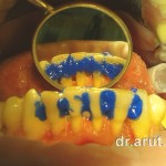 Протравливание шинируемых зубов