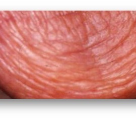 Синдром Гужеро—Шегрена