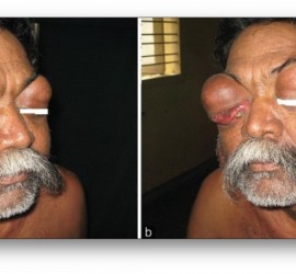 Синдром Микулича