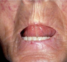 Склеродермия