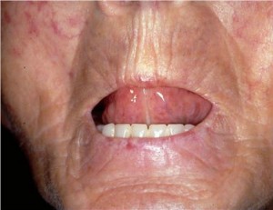 Склеродермия