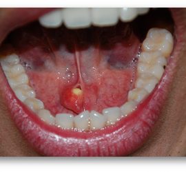 Слюннокаменная болезнь