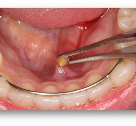Слюннокаменная болезнь поднижнечелюстной слюнной железы у детей