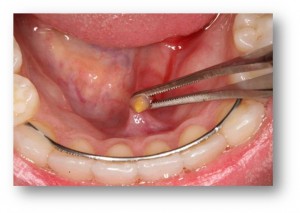 Слюннокаменная болезнь поднижнечелюстной слюнной железы у детей