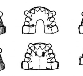 Съемные пластинки с секторальными распилами для удлинения зубного ряда.