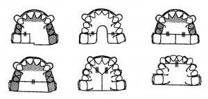 Съемные пластинки с секторальными распилами для удлинения зубного ряда.