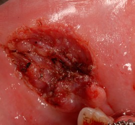 Механические поражения слизистой полости рта