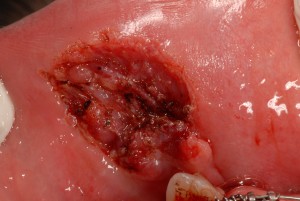 Механические поражения слизистой полости рта