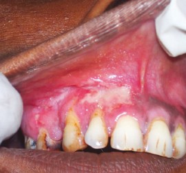 Туберкулез слизистой оболочки полости рта