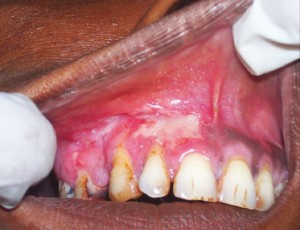 Туберкулез слизистой оболочки полости рта