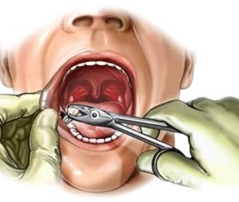 Показания и противопоказания к удалению постоянных зубов