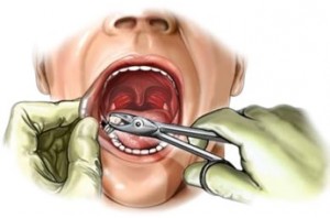 Показания и противопоказания к удалению постоянных зубов