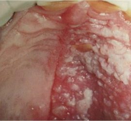 Ветряная оспа