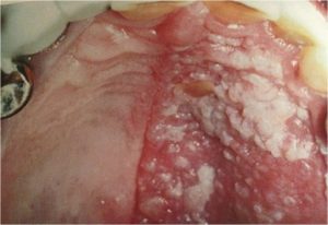 Ветряная оспа