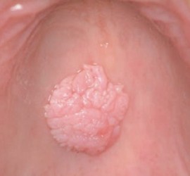 Вирусная бородавка на твёрдом нёбе