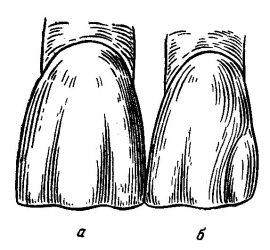 Боковой резец верхней челюсти