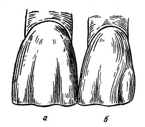 Боковой резец верхней челюсти