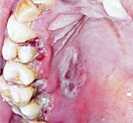 Стоматит язвенно-некротический Венсана