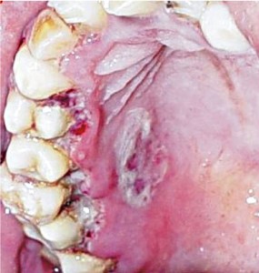 Стоматит язвенно-некротический Венсана