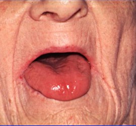 Анемия гипохромная