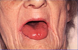 Анемия гипохромная