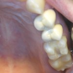 Зуб отпрепарированный под керамическую вкладку