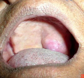 Цистаденоидная карцинома