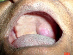 Цистаденоидная карцинома