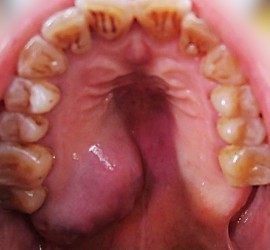 Аденокарцинома