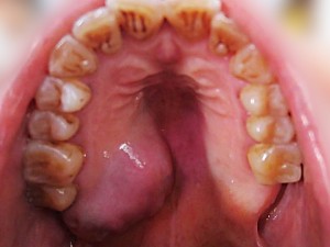 Аденокарцинома