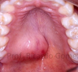 Аденома плеоморфная (полиморфная, смешанная опухоль)