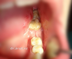 Адгезивный мостовидный протез - исходная картина