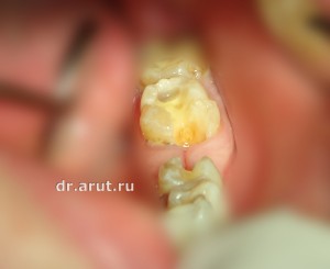 Адгезивный мостовидный протез - после препарирования опорных зубов
