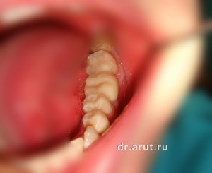 Адгезивный мостовидный протез - после фиксации