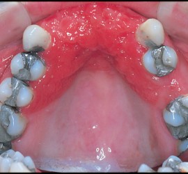 Акриловый стоматит