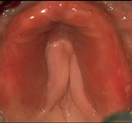 Аллергия при пользовании протезами