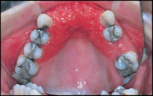 Акриловый стоматит