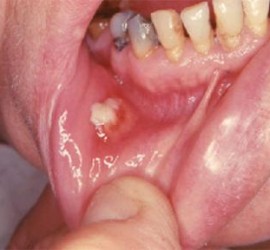 Актиномикоз