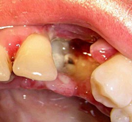Альвеолит (воспаление лунки зуба)