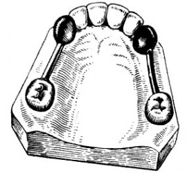 Балочное крепление протеза