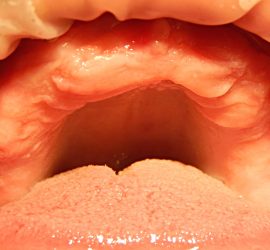 Беззубая челюсть