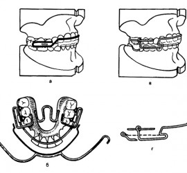 Бионатор Янсон на моделях челюстей, сложенных в конструктивном прикусе (а) и с лицевой дугой — вид сверху (б); устройство Хорошилкиной и Токаревича на моделях челюстей (в), натяжение резинового кольца между крючками (г)