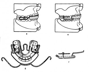 Бионатор Янсон на моделях челюстей, сложенных в конструктивном прикусе (а) и с лицевой дугой — вид сверху (б); устройство Хорошилкиной и Токаревича на моделях челюстей (в), натяжение резинового кольца между крючками (г)
