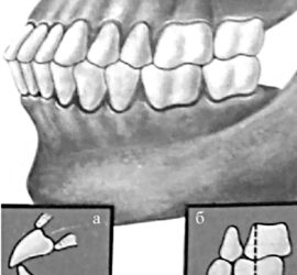 Бипрогнатия