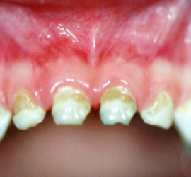 Циркулярный кариес