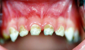 Циркулярный кариес